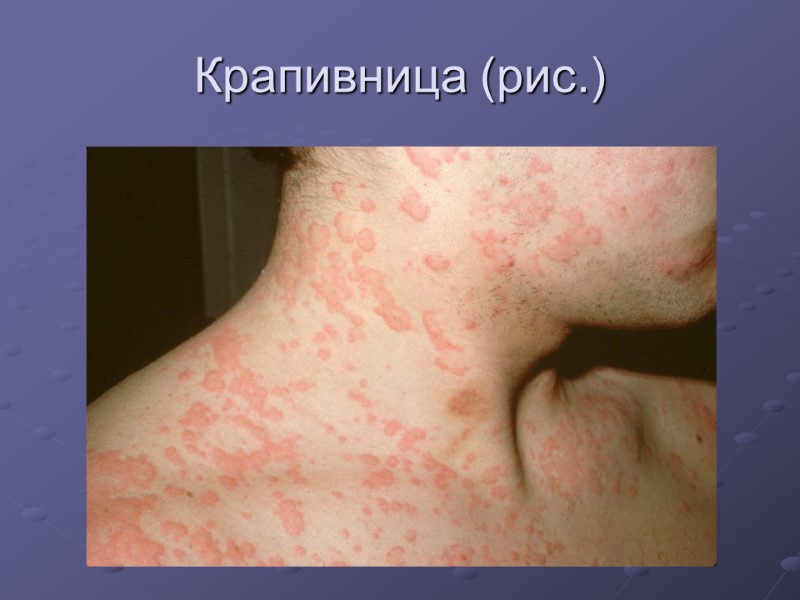 Крапивница (рис.)